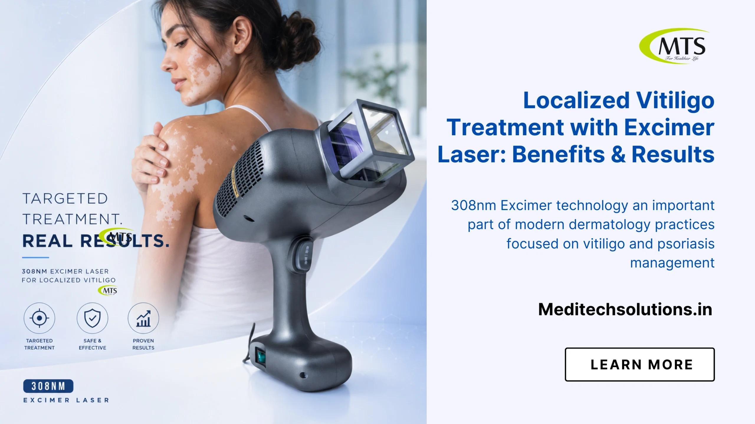 Localized Vitiligo Treatment with Excimer Laser: Benefits, Cost & Results